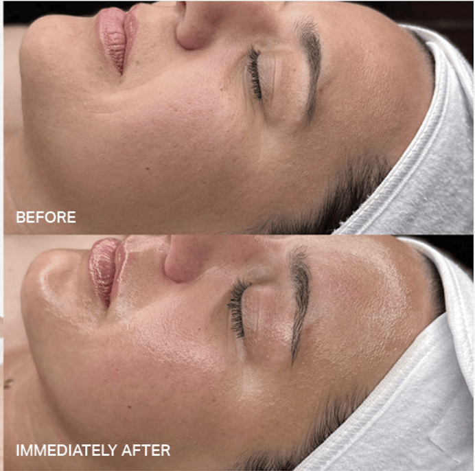 immediate glow after hydrafacial