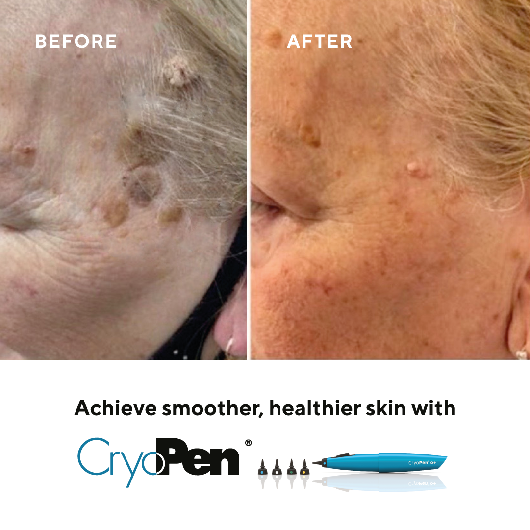 Before and after images showing skin improvement. The skin in the after photo appears clearer and smoother. Text promotes CryoPen for achieving smoother, healthier skin.