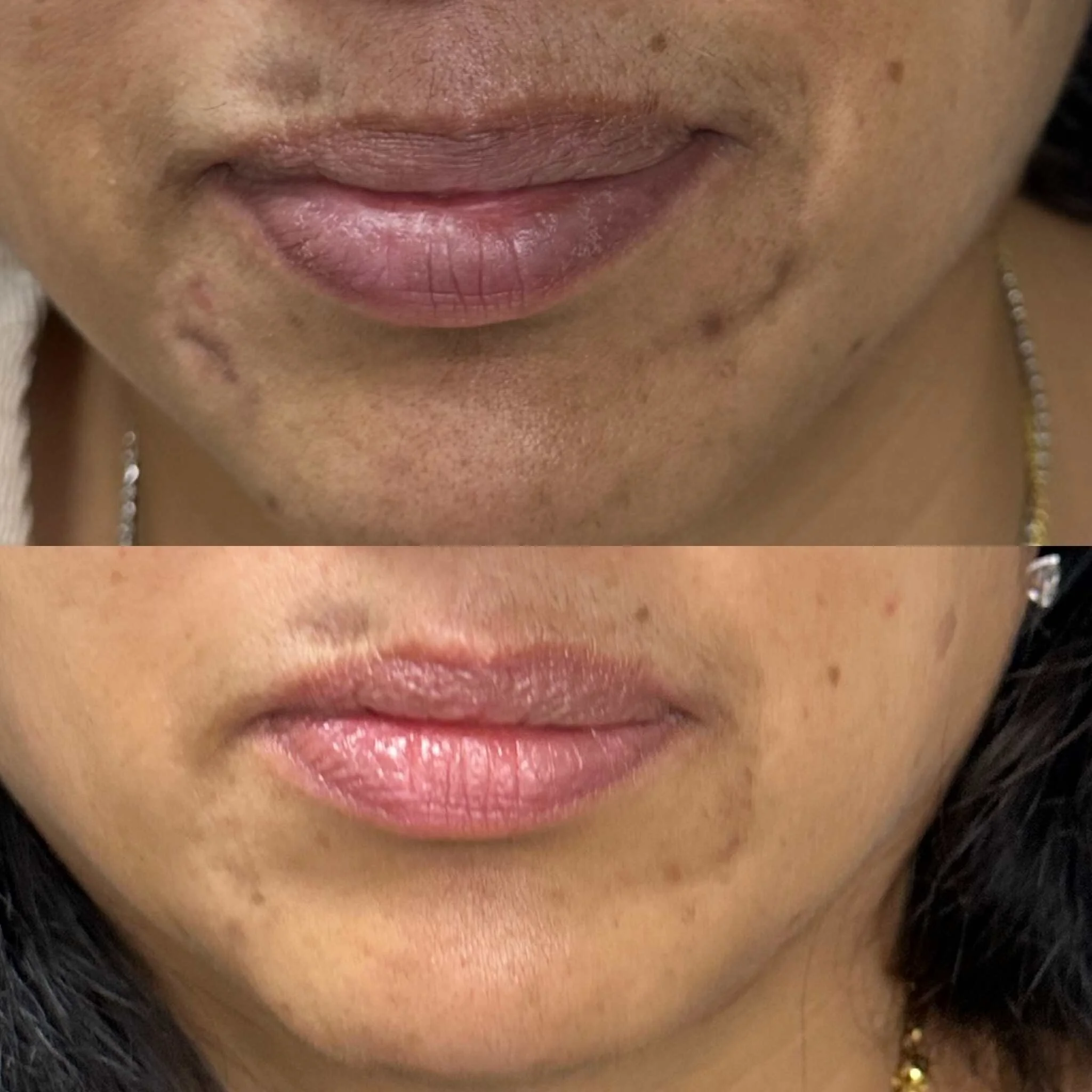 Pigmentation_Peel_New_Malden