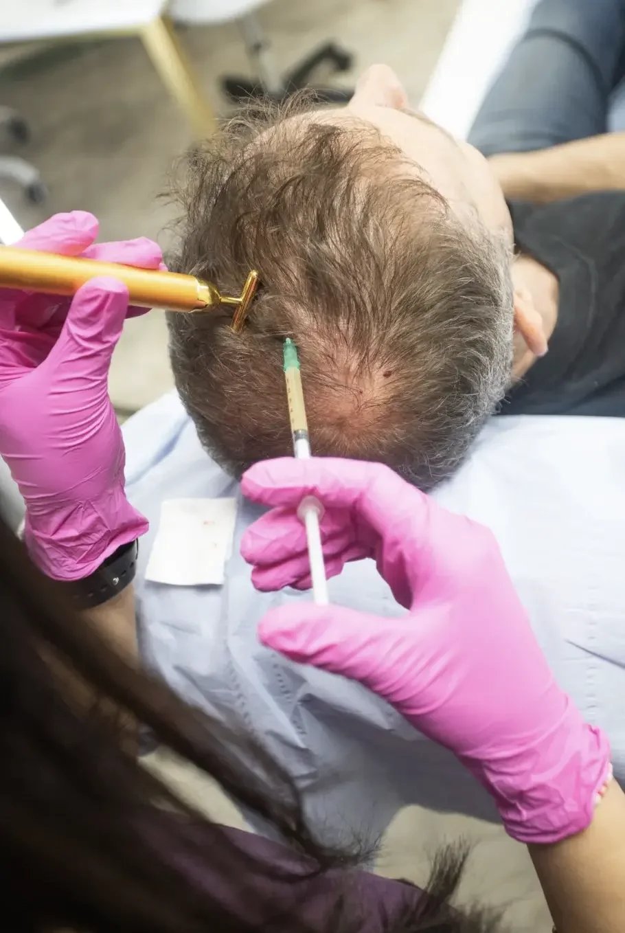A person wearing pink gloves administering a vaccine or injection into a patient's scalp, possibly for hair treatment or hair loss.