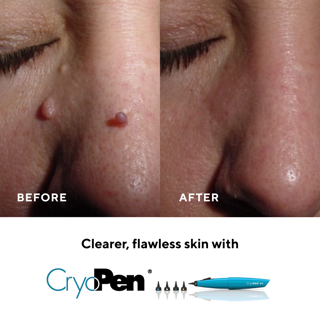 Comparison of a person's nose before and after using CryoPen, with visible reduction in skin blemishes and improved skin clarity.