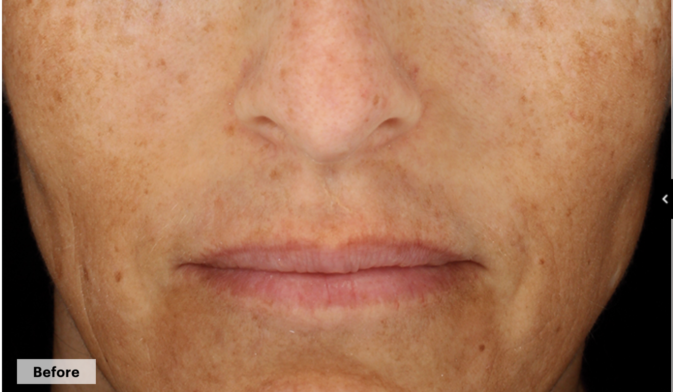 before cosmelan treatment