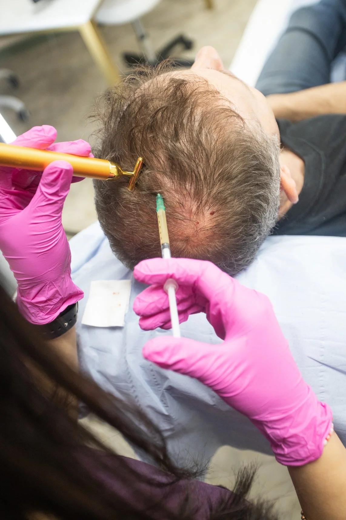 prp-hair-loss-treatment-for-scalp-hair-regrowth-at-aesculus-clinic