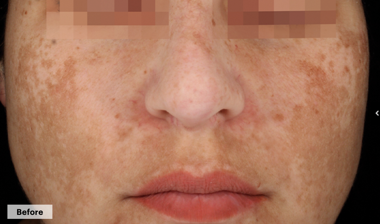 Before-cosmelan-treatment-aesculus-clinic