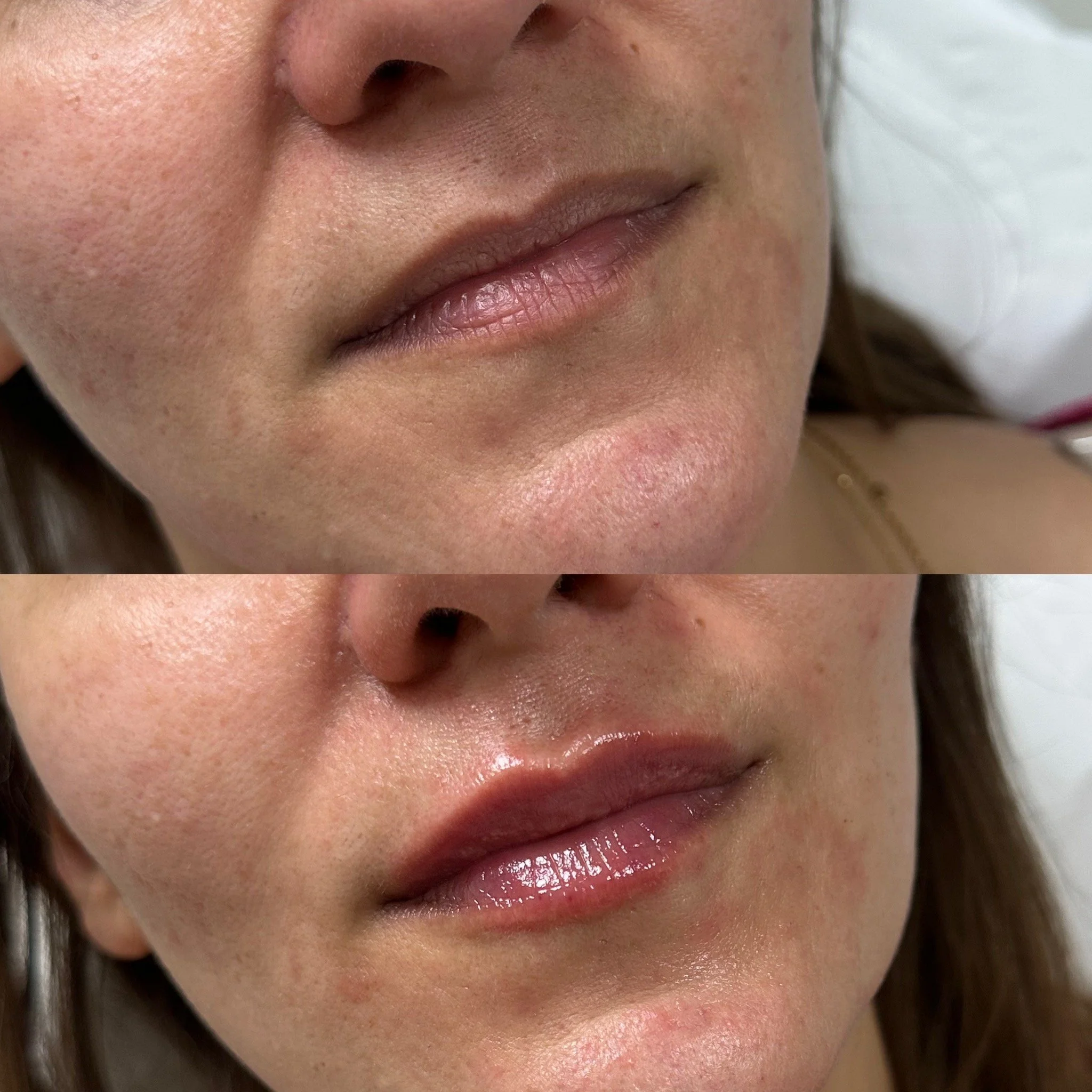 Lip Filler in New Malden