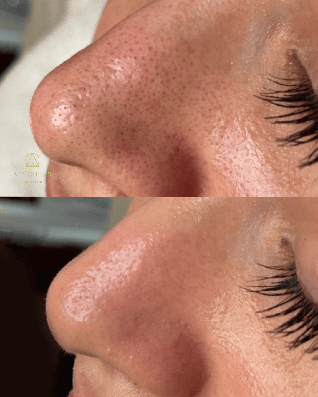 Hydrafacial clears blackheads