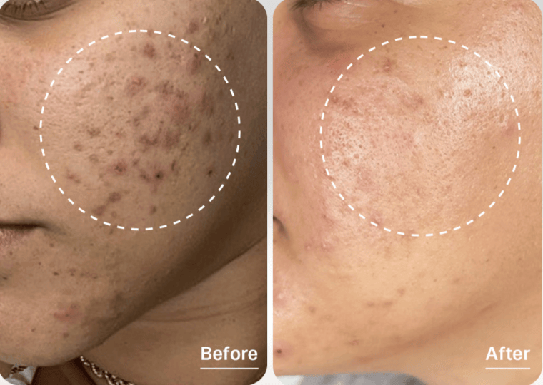 hydrafacial to brighten skin