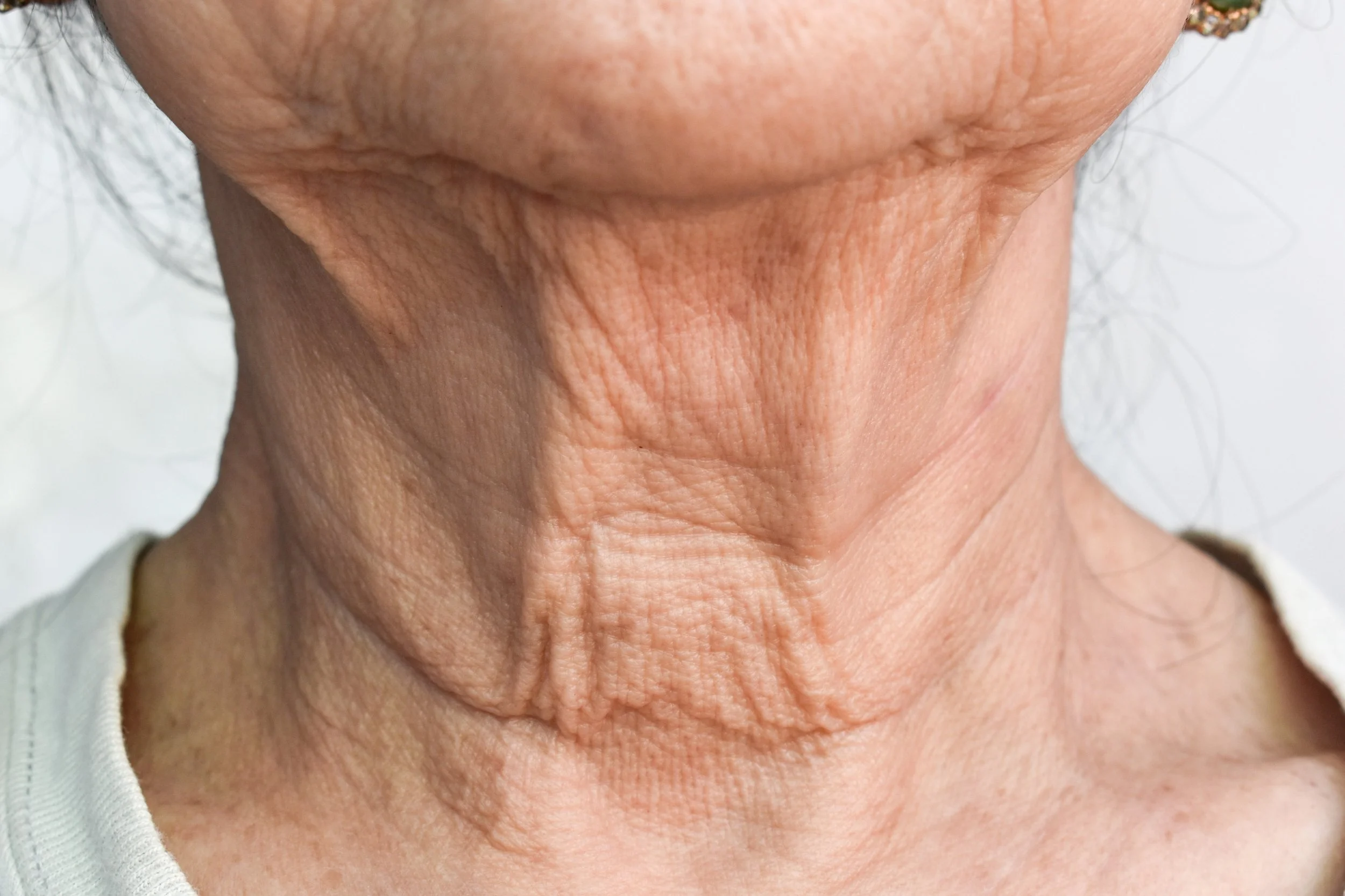 Treatment-for-wrinkly-neck-aesculus-clinic