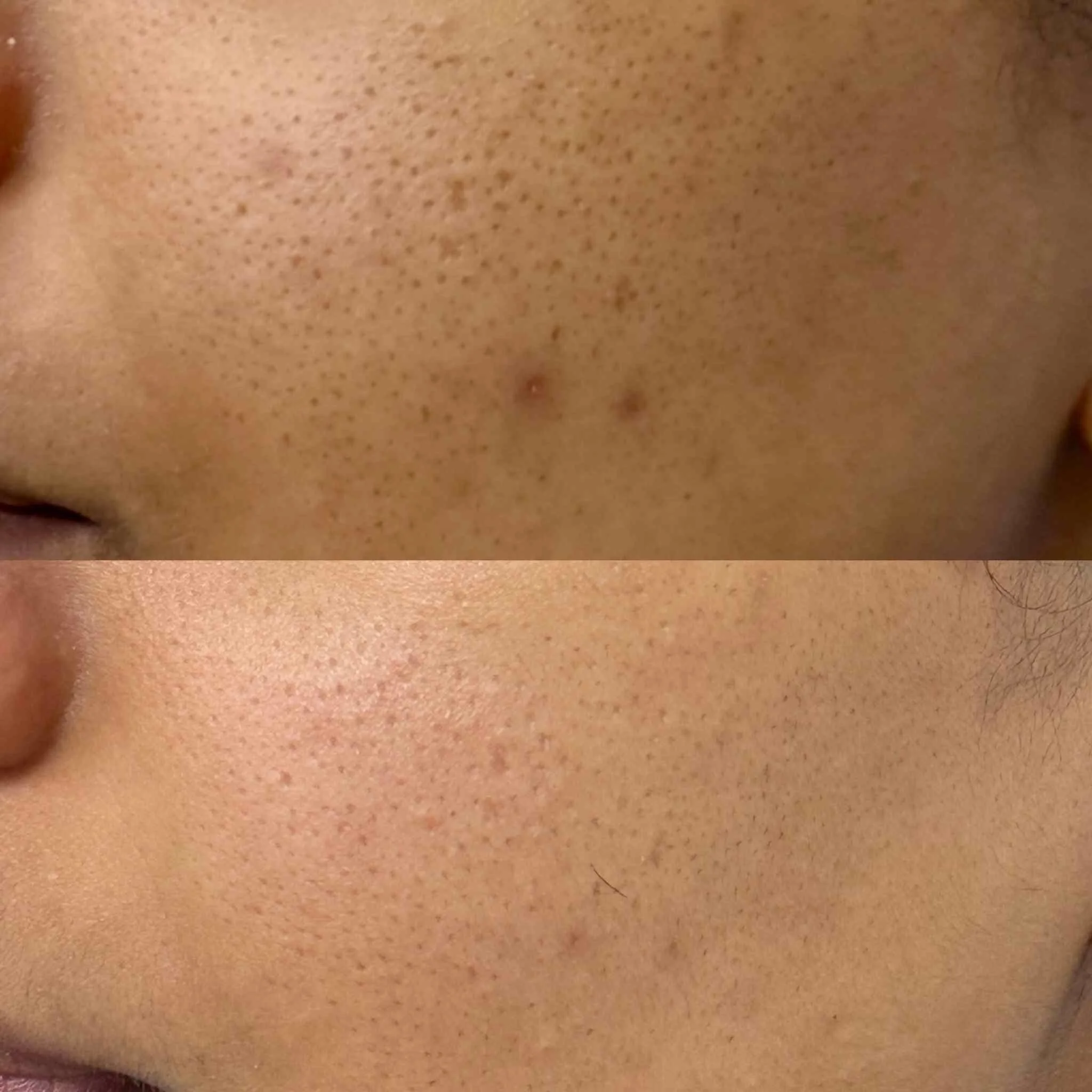 Acne_peel_New_malden