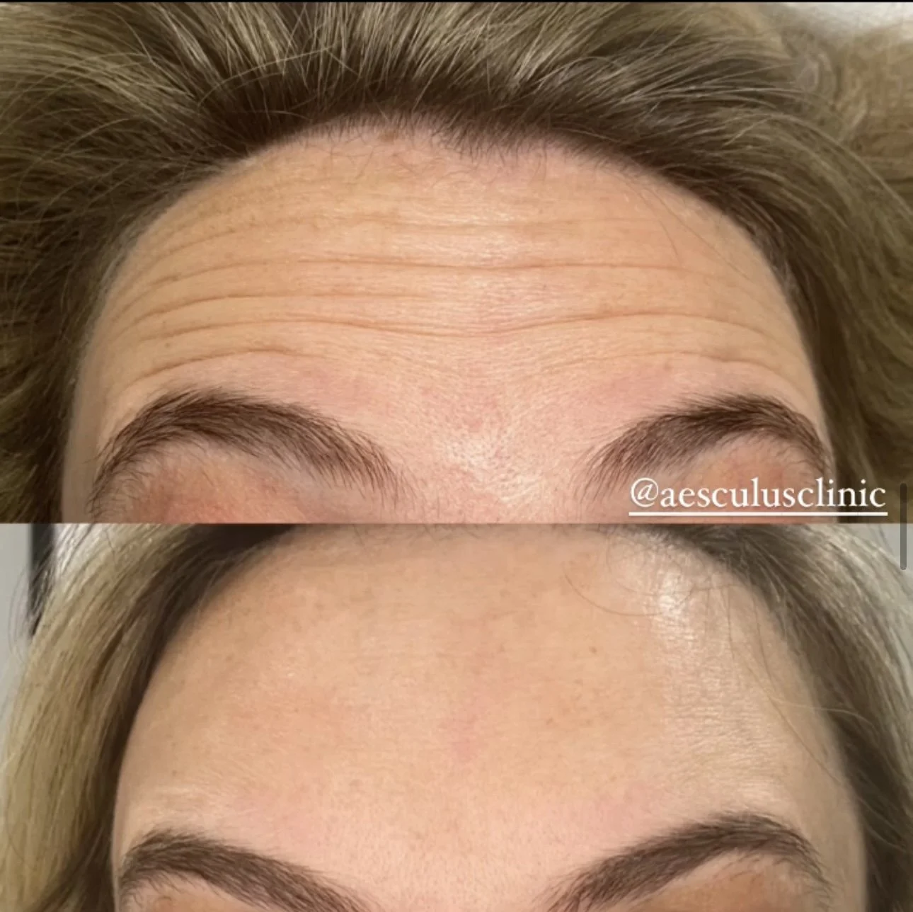 Close-up -comparison -of -a- woman's- forehead -before -and- after- cosmetic -treatment-showing-reduced-wrinkles-and -smoother-skin-aesculus-clinic