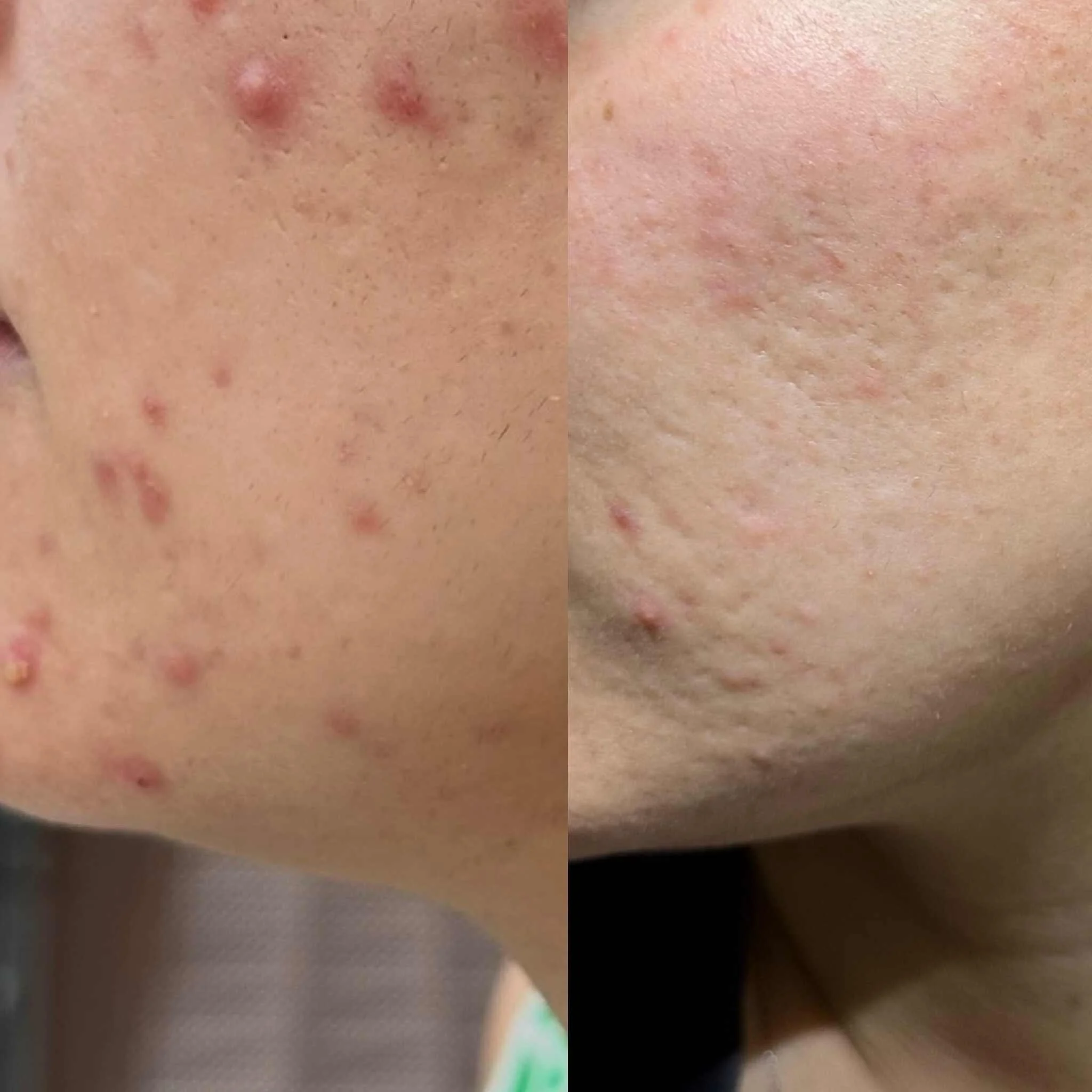 Acne_treatment_Kingston