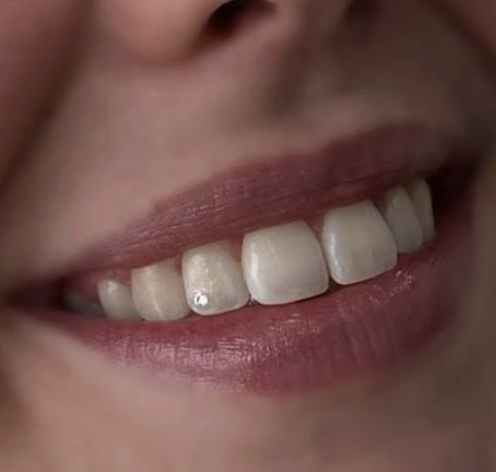 One tooth gem