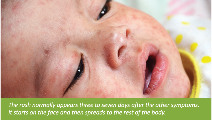 Close-up of a baby's face with rash spots around the nose and cheeks.