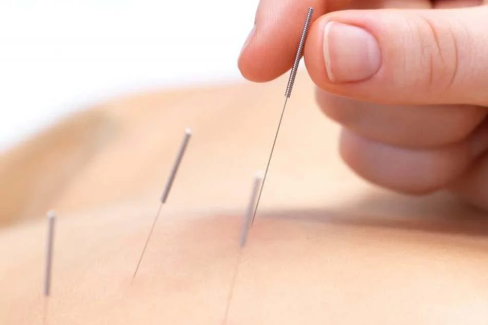 Acupuncture + Traditional Chinese Medicine