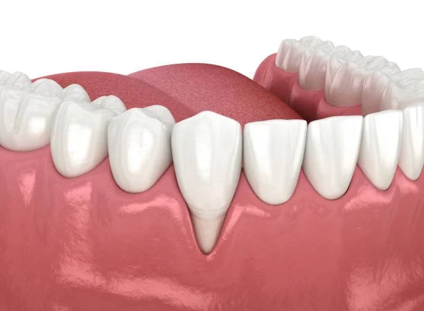 Gum recession - best Periodontist in UWS Upper West Side - West Side Family Dental Group