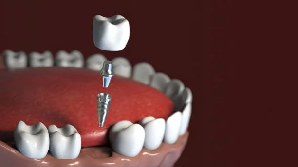 Best dental implants at family dentist in Upper West Side Manhattan