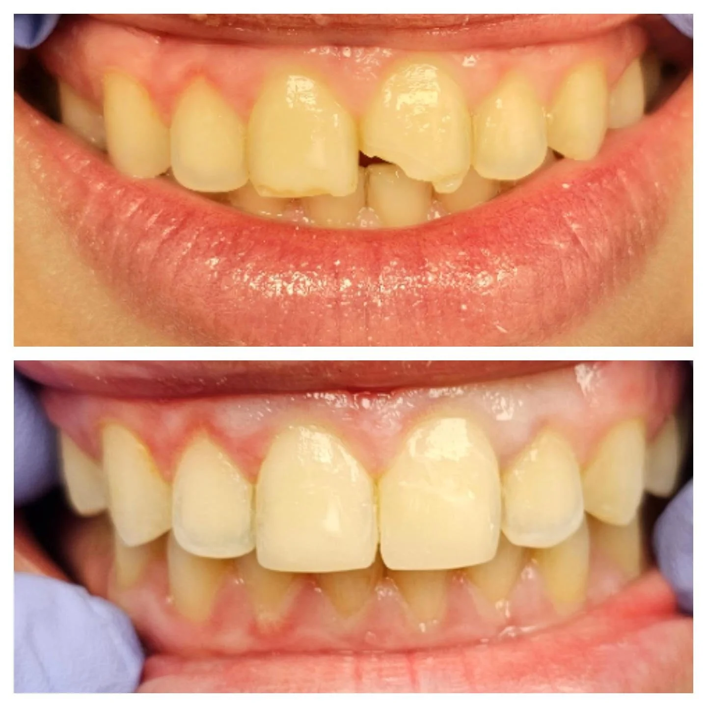 Close-up of a person's teeth before and after dental treatment, showing improved alignment and appearance.