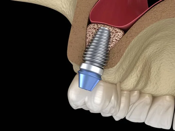 Best Dental Implant in UWS Upper West Side Manhattan - West Side Family Dental Group