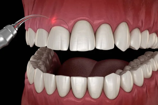 Best cosmetic dentistry and gingivectomy. Gum surgery. Smile makeover