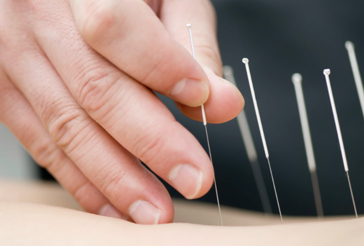 https://www.dermatologytimes.com/view/acupuncture-reduces-frown-lines-in-clinical-trial