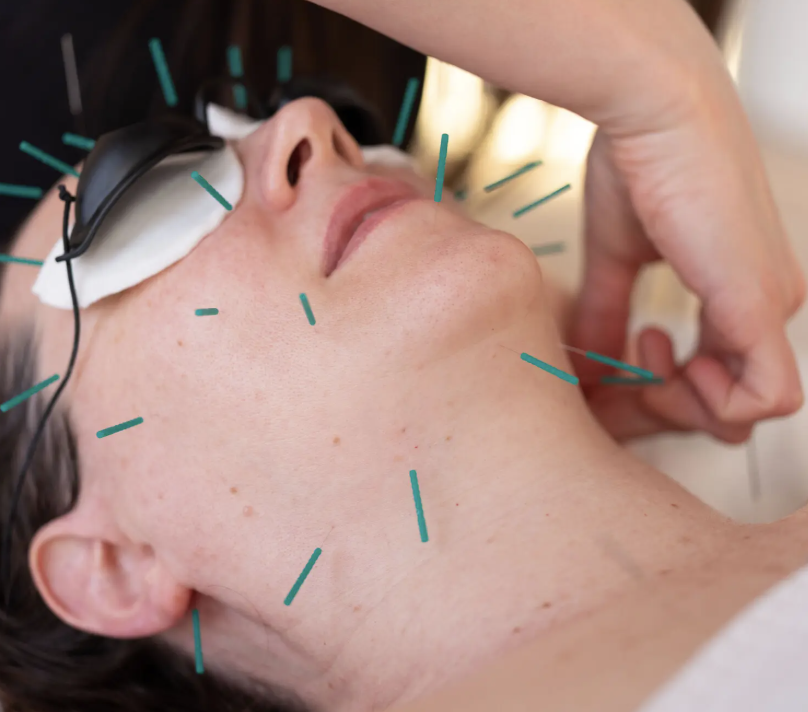 https://www.nytimes.com/2025/08/07/style/cosmetic-acupuncture-botox-notox-skin-care.html