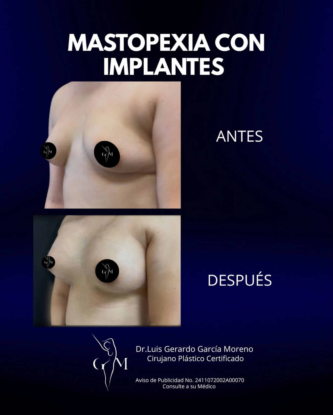 📍 Agenda tu valoraci&oacute;n m&eacute;dica.
Dr. Luis Gerardo Garc&iacute;a Moreno | Cirujano Pl&aacute;stico Reconstructivo
Especialista en Cirug&iacute;a Facial y Corporal.
Innovaci&oacute;n en Tratamientos Avanzados con Tecnolog&iacute;a 
Redefin