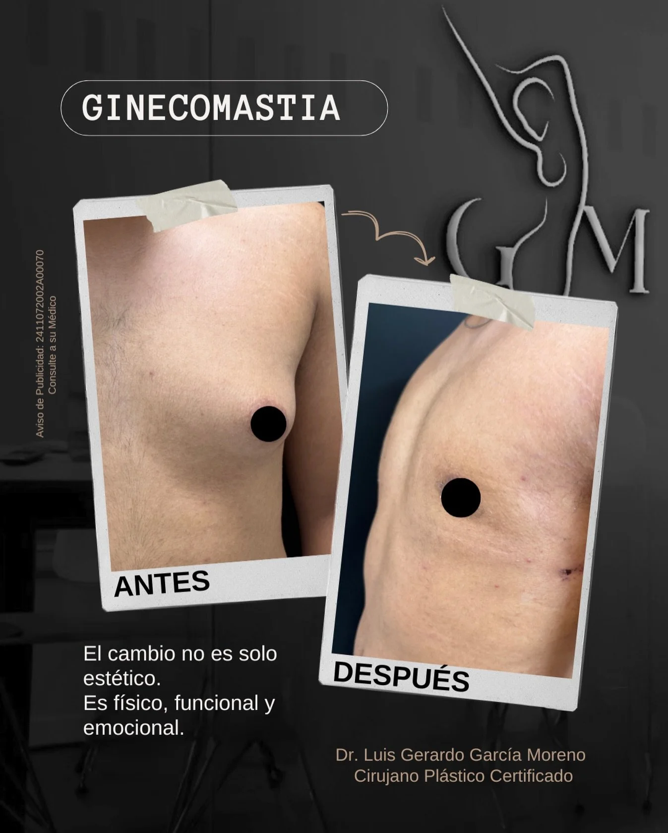 La ginecomastia es el crecimiento anormal de tejido mamario en hombres.
No es solo un tema est&eacute;tico, es una condici&oacute;n real.

Corregirla permite recuperar un contorno tor&aacute;cico firme, plano y masculino.

Con una t&eacute;cnica adec