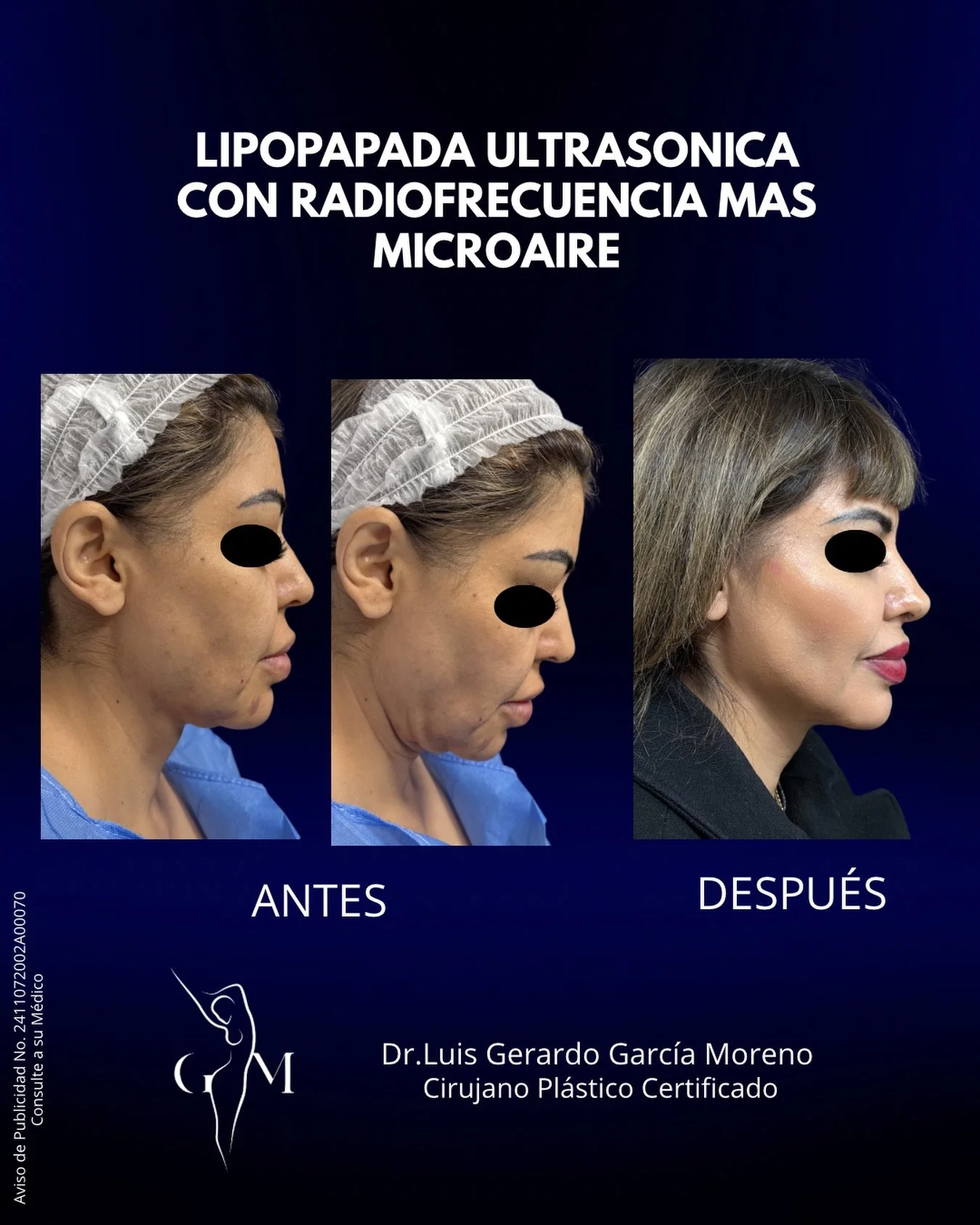 No es solo quitar grasa&hellip; es redefinir tu perfil.
La lipopapada ultras&oacute;nica con radiofrecuencia m&aacute;s microaire afina, tensa y rejuvenece en un solo procedimiento.

Agenda tu cita.
Dr. Luis Gerardo Garc&iacute;a Moreno | Cirujano Pl