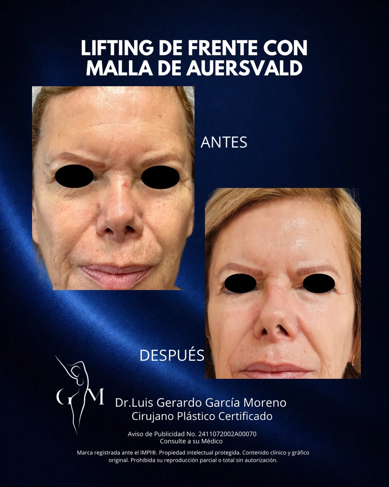 Rejuvenecer la frente tambi&eacute;n transforma la mirada. 
Con la malla de Auersvald logramos elevaci&oacute;n, definici&oacute;n y resultados visibles desde etapas tempranas de recuperaci&oacute;n.

Agenda tu valoraci&oacute;n.

Dr. Luis Gerardo Ga