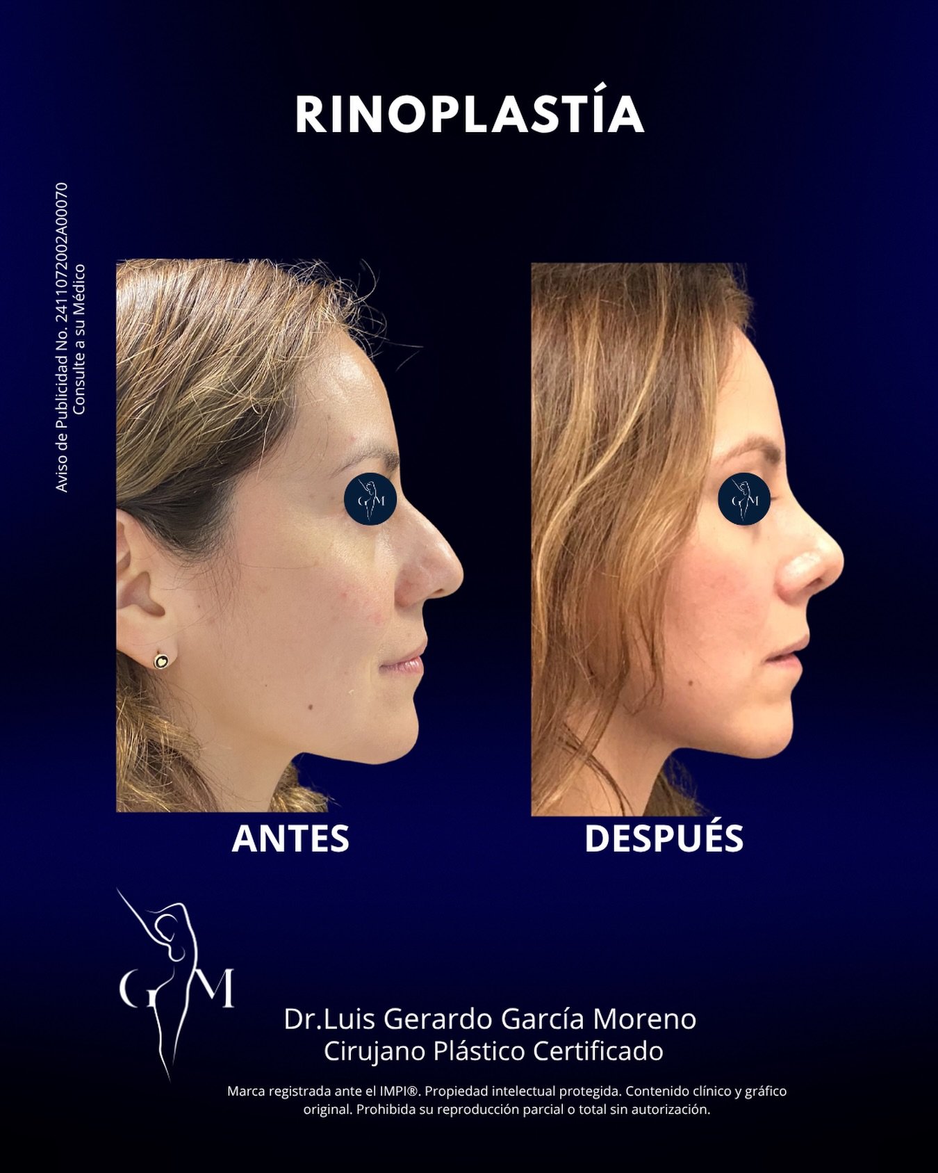 Una rinoplastia bien hecha busca armonizar con todo tu rostro, haciendo que el resultado se vea natural, sofisticado y en equilibrio con tus facciones. 
Agenda tu cita de valoraci&oacute;n 
Dr. Luis Gerardo Garc&iacute;a Moreno | Cirujano Pl&aacute;s