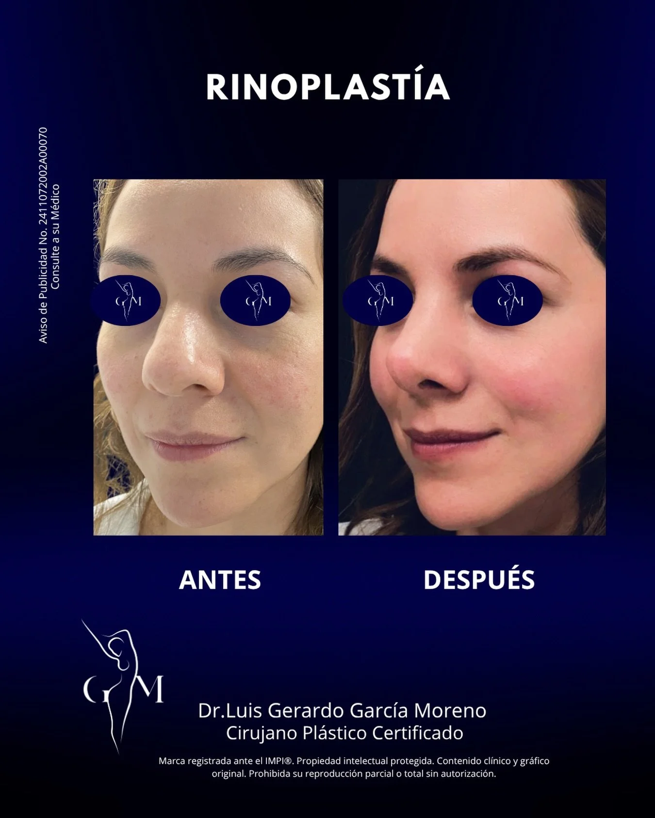 Una nariz en equilibrio con el rostro puede transformar la forma en que se perciben tus facciones, manteniendo siempre la naturalidad.

📍Valoraci&oacute;n m&eacute;dica previa indispensable.

Dr. Luis Gerardo Garc&iacute;a Moreno | Cirujano Pl&aacut