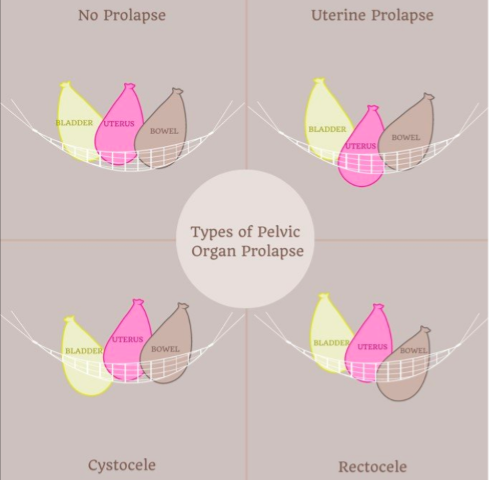 Diagram showing different types of pelvic organ prolapse: no prolapse, uterine prolapse, cystocele, and rectocele, with labeled illustrations of the bladder, uterus, bowel, and their positions.