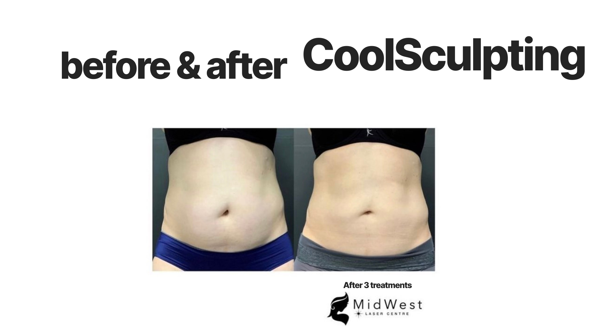 Side-by-side comparison of a person's midsection before and after three CoolSculpting treatments, showing reduced abdominal fat.