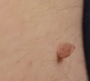 •	skin tags