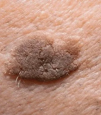 •	seborrheic keratosis