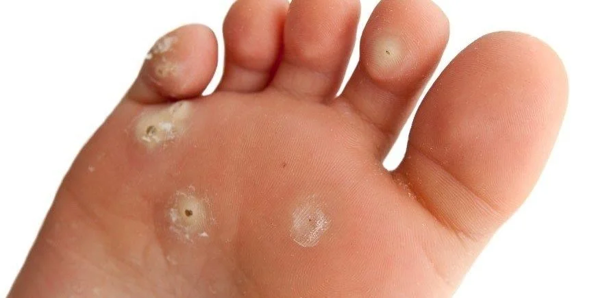 Close-up of a child's hand showing multiple blisters on the fingers and palm.