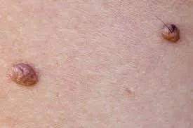 •	superficial benign moles (nevus)**