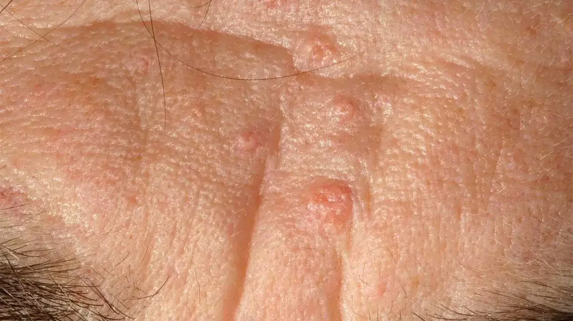 •	seborrheic hyperplasia 