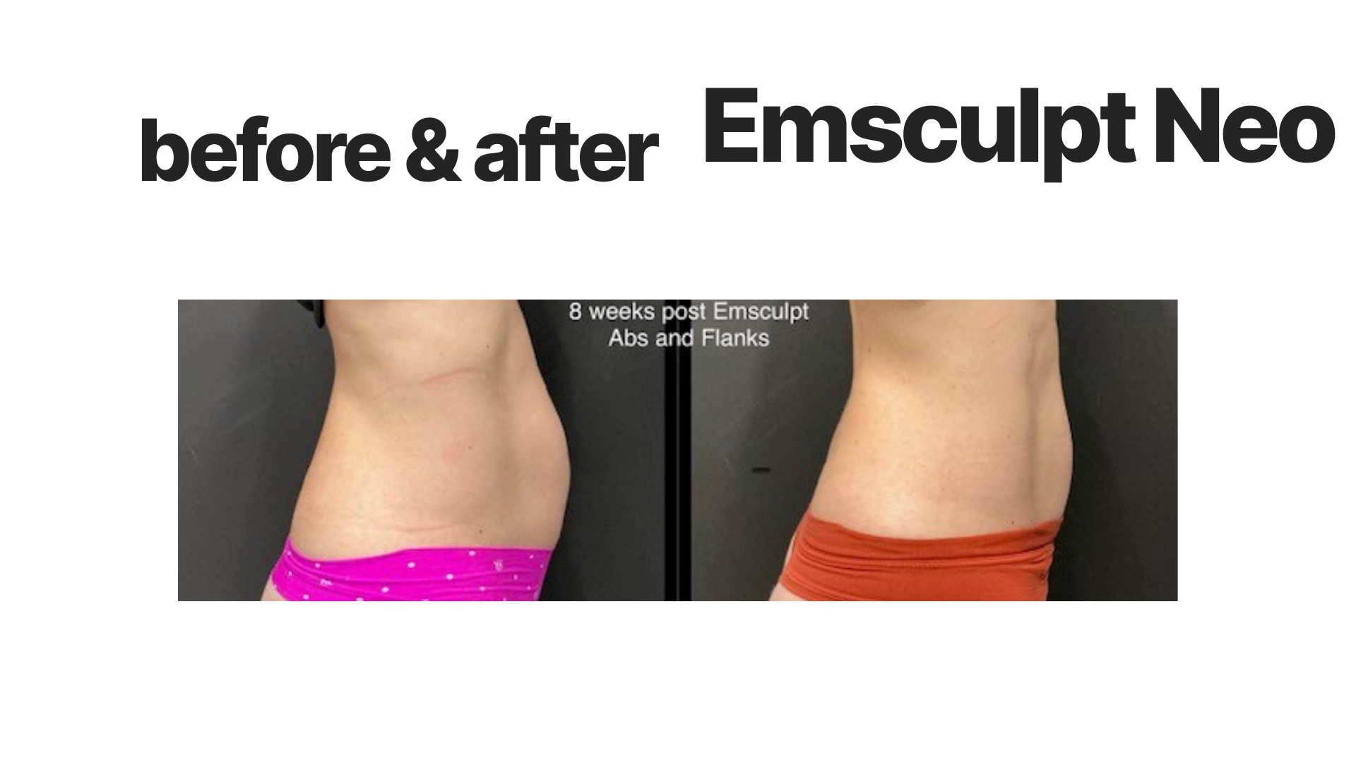 Side-by-side comparison of a woman's abdomen before and after 8 weeks of Emsculpt Neo treatment, showing reduced fat and more toned appearance.