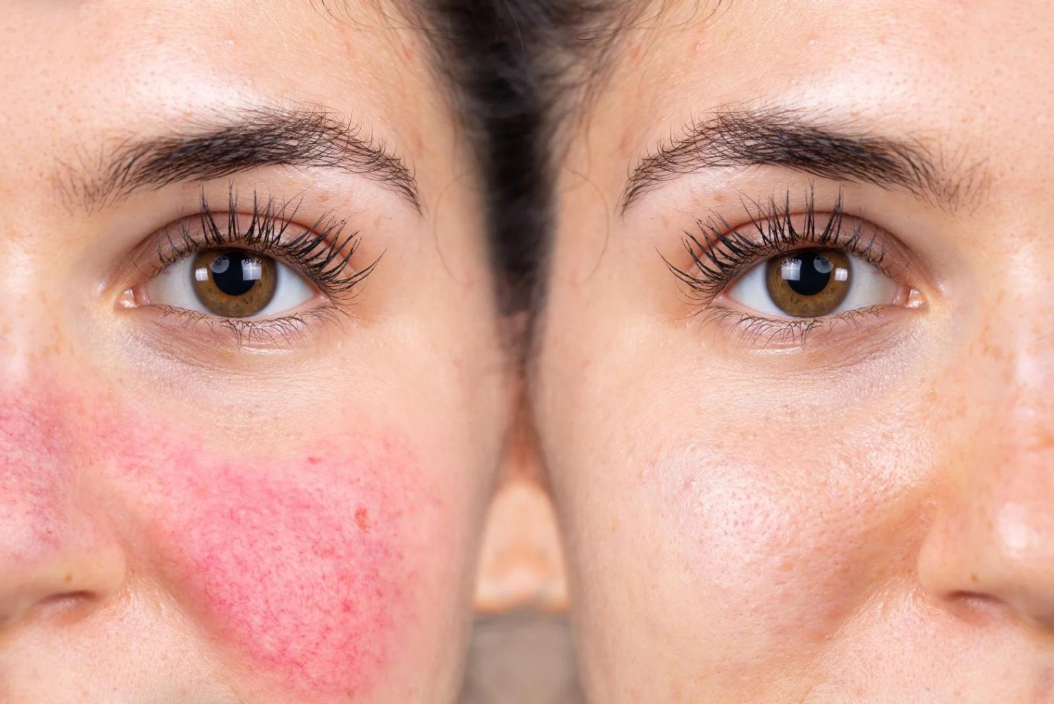 Close-up of a woman's face showing one cheek with redness and irritation, and the other side clear with smooth skin.