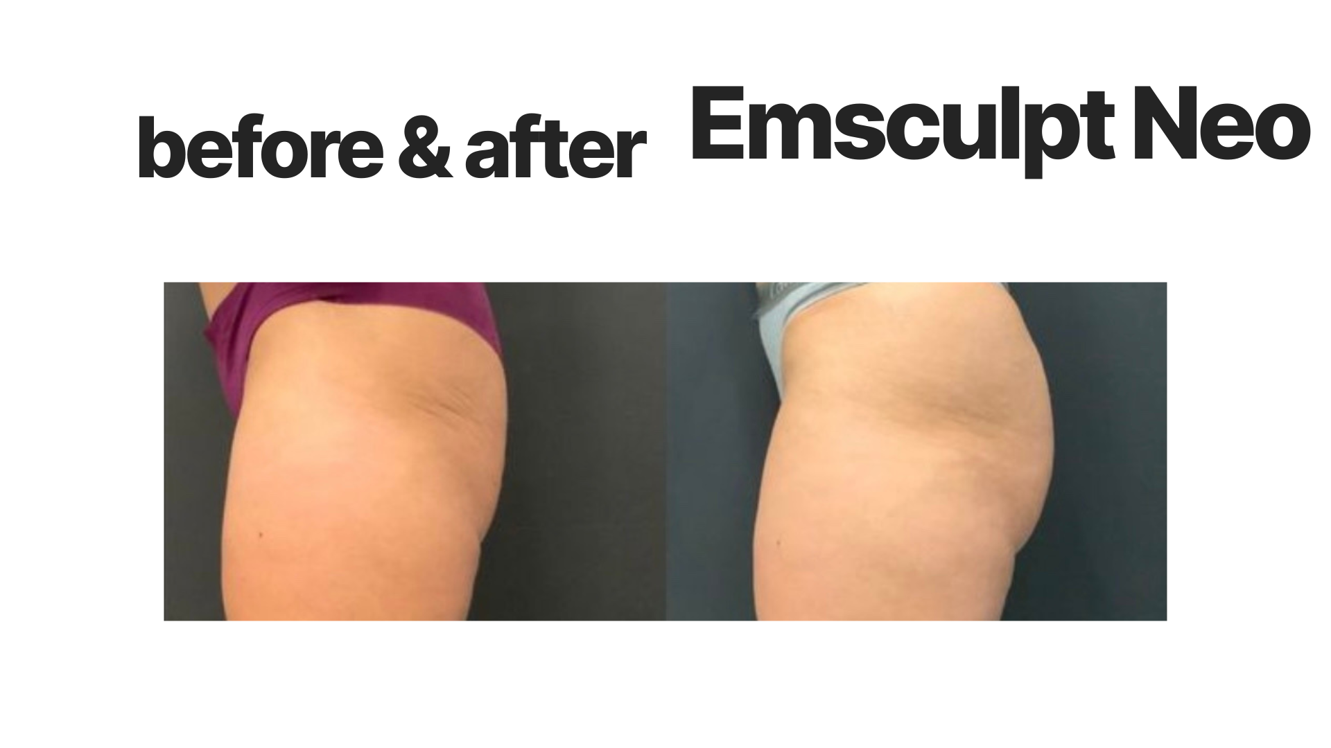 Comparison photo showing a person's buttocks before and after Emsculpt Neo treatment, with visible skin tightening and contouring improvements.