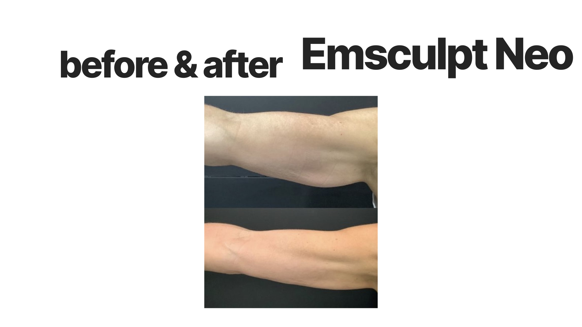 Comparison of forearm before and after Emsculpt Neo treatment, showing increased muscle size and tone.