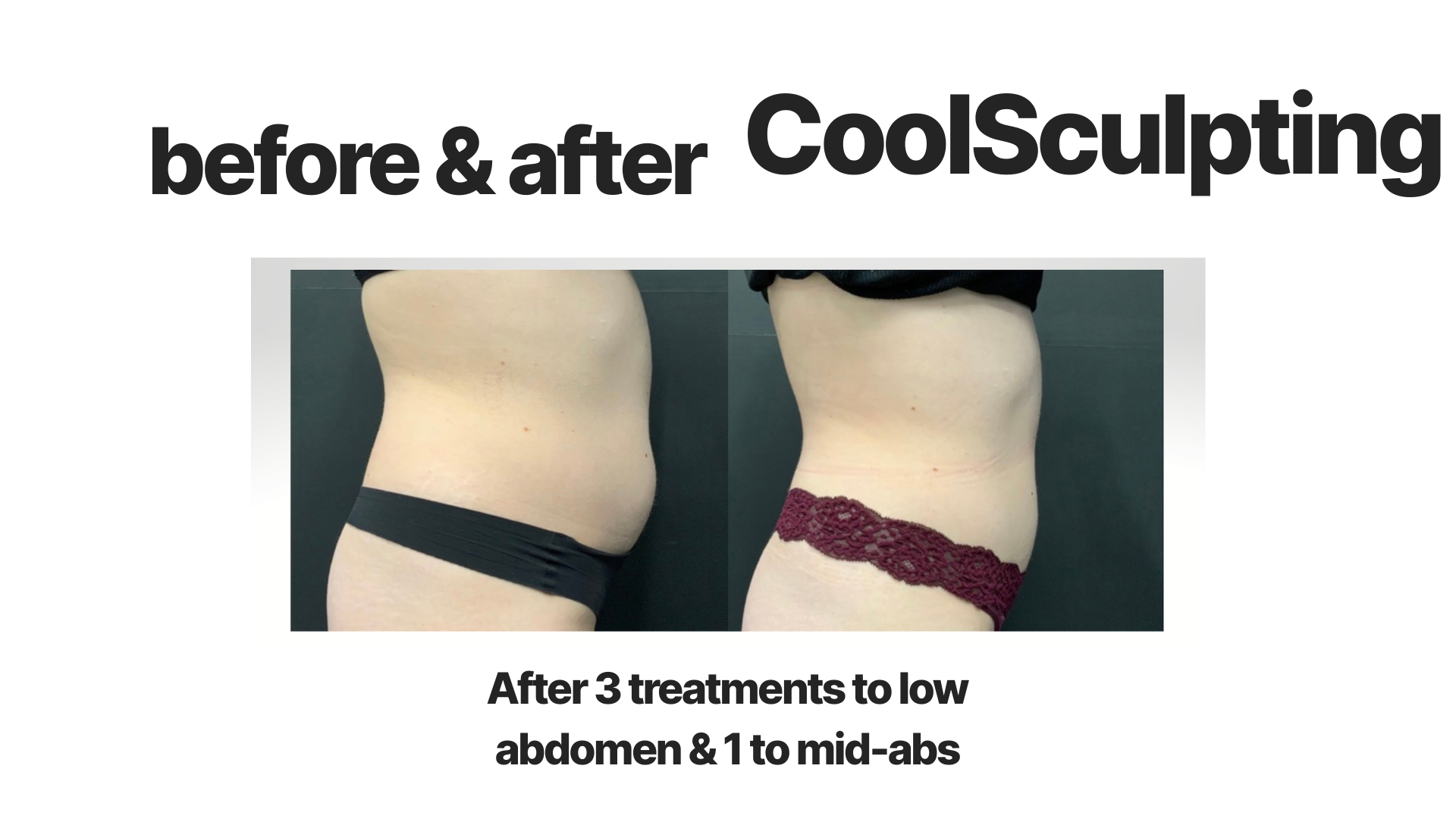 Comparison photo showing a person's torso before and after CoolSculpting treatments, highlighting reduction in low abdomen and mid-abs area.