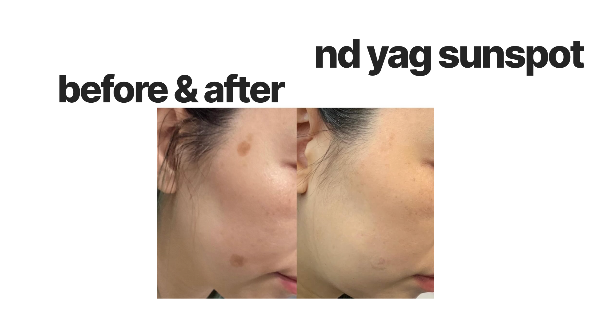 Before-and-after close-up of cheek showing reduced acne marks and hyperpigmentation