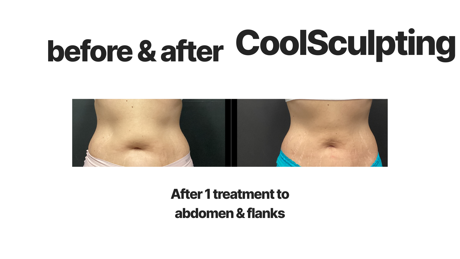 Side-by-side comparison of a woman's abdomen before and after CoolSculpting treatment, showing reduction in fat and improved contour.