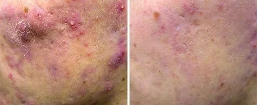 before and after adult acne with treatment using Fotona