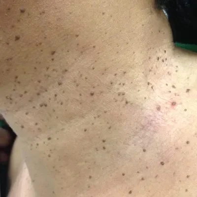 •	dermatosa papulosa nigra (DPN)