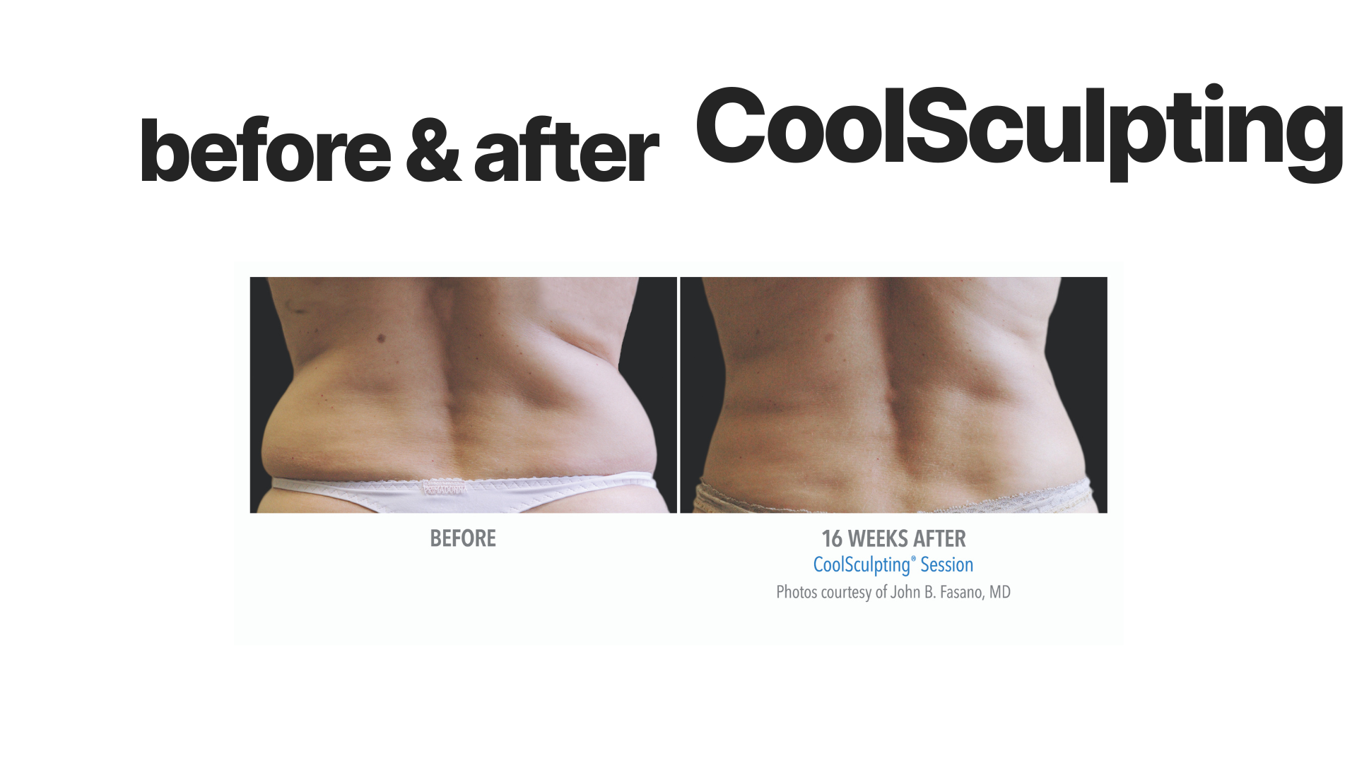 Side-by-side before and after photos showing the lower back and waist of a person, with noticeable reduction in fat and improved contour after a CoolSculpting session.