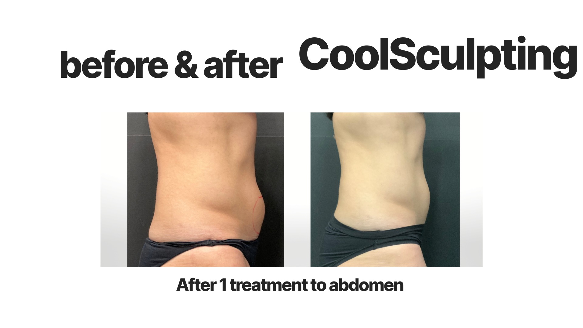 Comparison of a person's abdomen before and after one CoolSculpting treatment, showing reduced fat and a more toned appearance.
