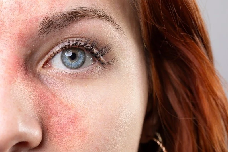 Close-up of a woman's face showing her blue eye, red hair, and slightly red skin on her cheek.